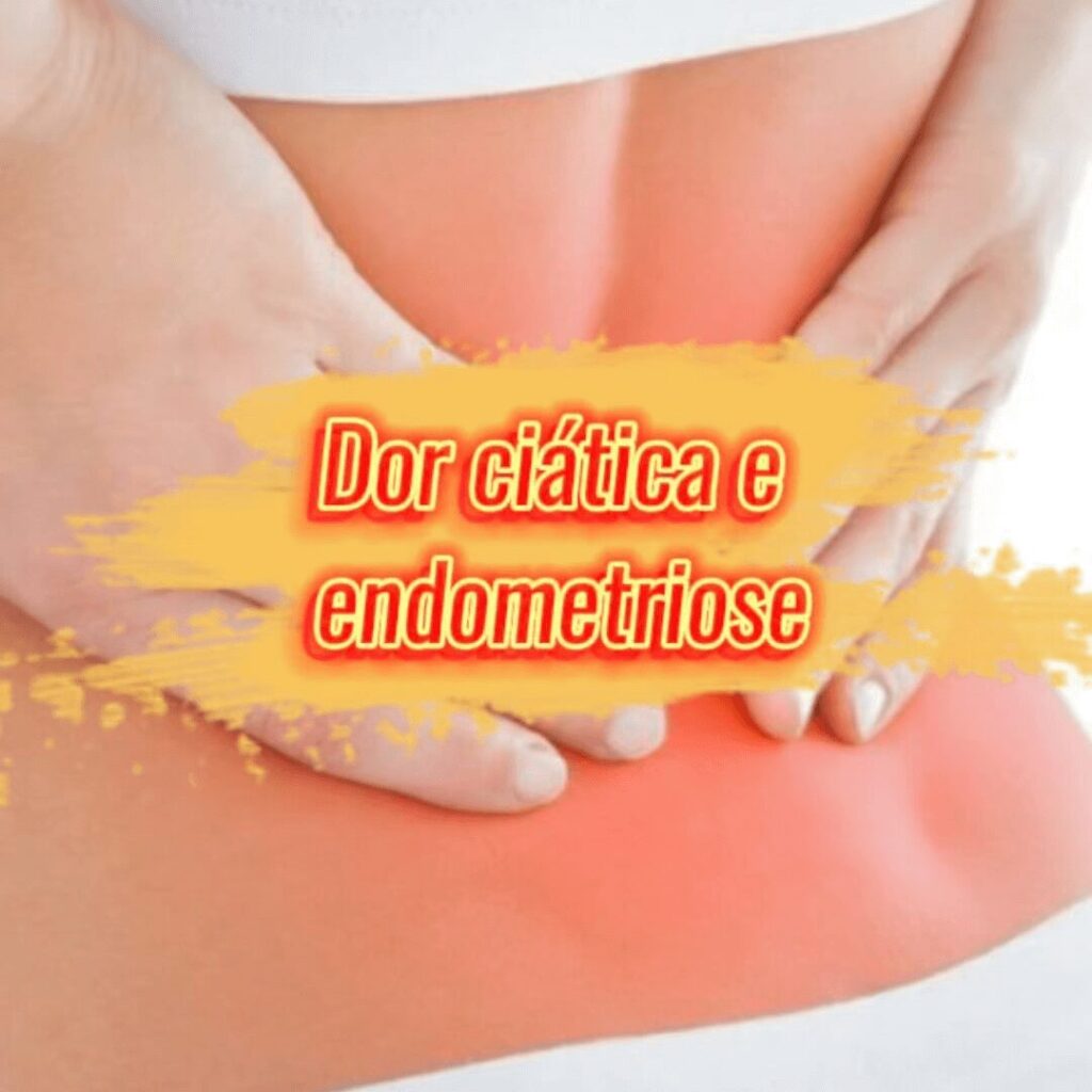 Dor ciática e endometriose
